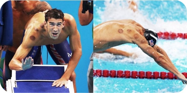 Michael Phelps with cupping therapy marks