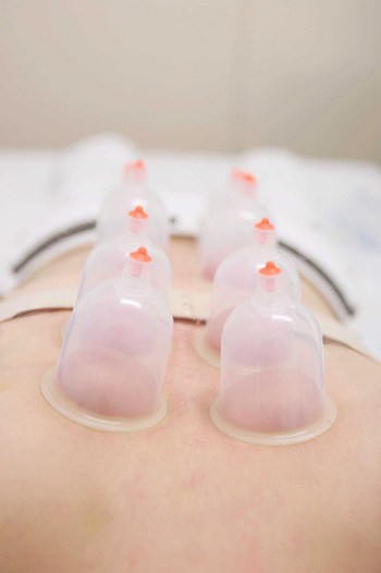 Cupping-Low-Back-Rivernorth-Acupuncture-Diamond-Bar